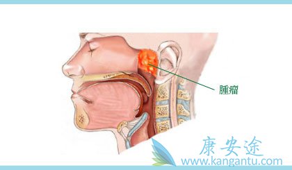 鼻咽癌症状比较多   鼻粘膜有炎症,经常吸烟,用手挖鼻孔或用力擤鼻涕